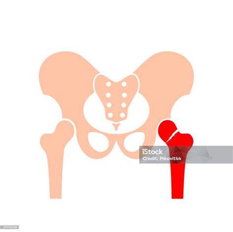 Hip Bone Fracture Stock Illustration - Download Image Now - Anatomy ...