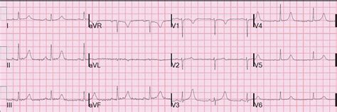 Dr. Smith's ECG Blog: November 2011