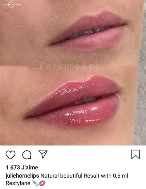 #lips fillers #lips kiss #lips natural #lips shape #lips women #without lipstick #fillers #Kiss ...