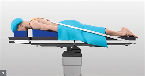 Minimally invasive posterior cervical fusion augments three-level ...