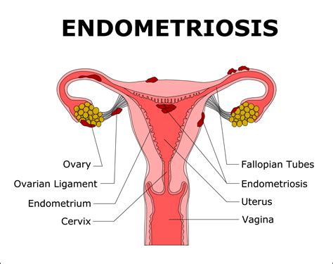 Blocked Fallopian Tube: Symptoms, Causes and Treatment