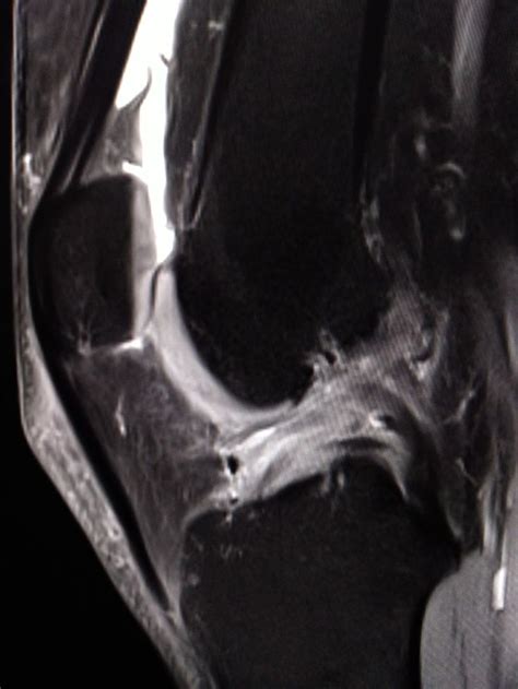 High grade tear of ACL | Radiology, Medicine, Nurse