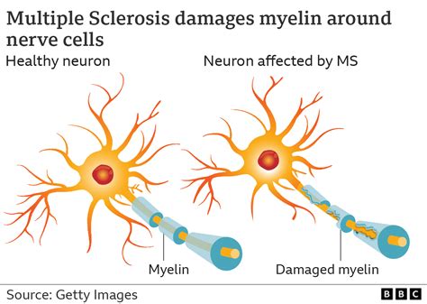 Multiple Sclerosis Neuron