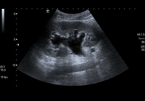 Hydronephrosis echocardiography or ultrasound - wikidoc