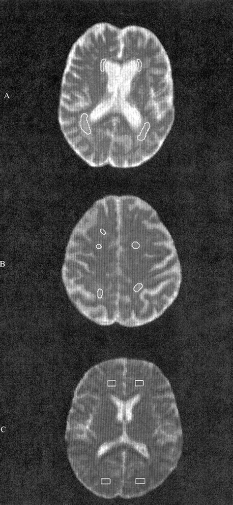 Leukoaraiosis, Ischemic Stroke, and Normal White Matter on Diffusion-Weighted MRI | Stroke