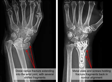 Distal Radius Bone Fracture