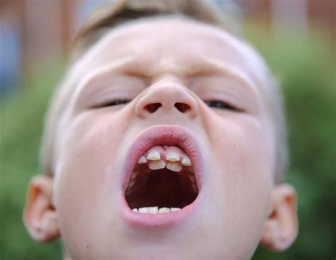 Two sets of teeth: Boy has paediatric shark teeth | Daily Star