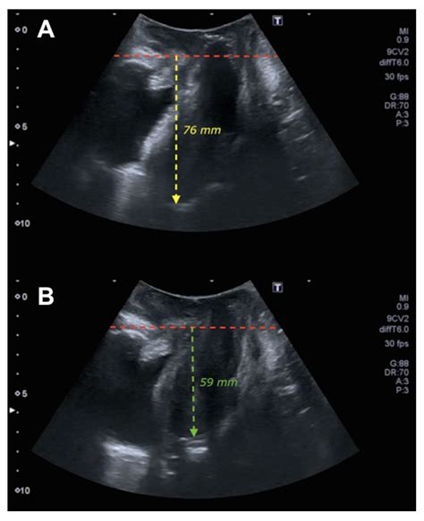 Tomography | Free Full-Text | Predictive Model for the Diagnosis of Uterine Prolapse Based on ...