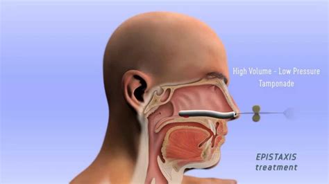 Epistaxis Treatment - 3D - YouTube