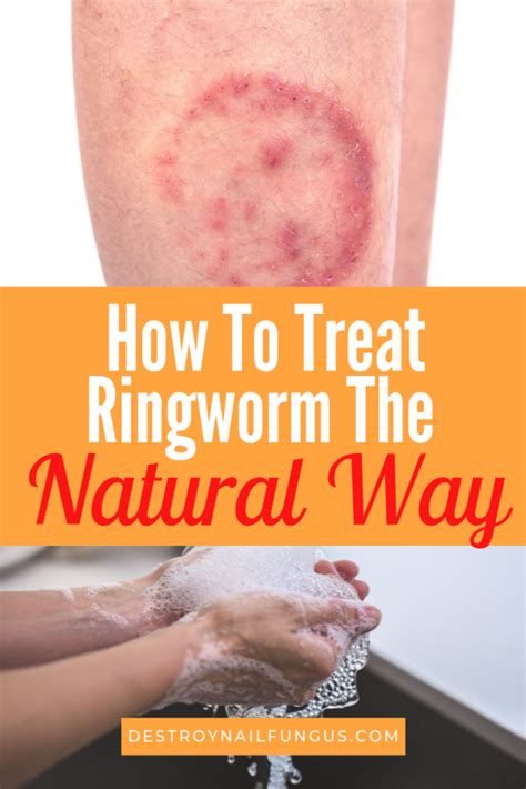 How To Treat Ringworm The Natural Way: What You Need To Know