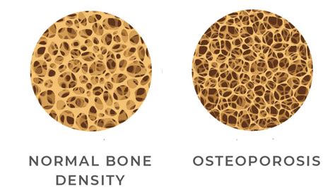 image showing normal bone density vs. osteoporosis - Imaging Center, Minimally Invasive Services