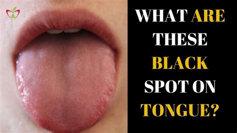 What Are These Black Spot On My Tongue || How to Get Rid of Black Spots On Tongue || - YouTube