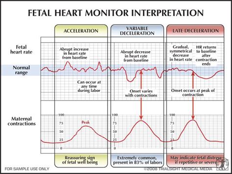 Heart Monitor Graph Lines at Stephen Armitage blog