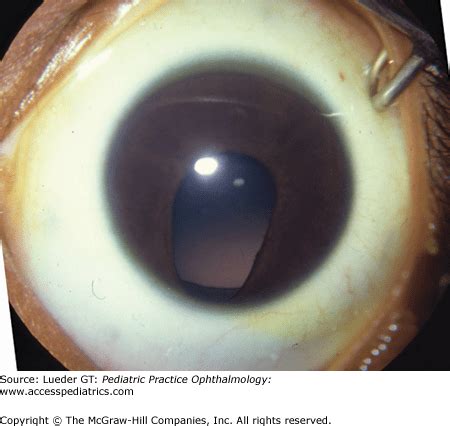 Disorders of the Iris and Pupil | Ento Key