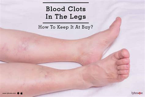 Blood Clots In The Legs - How To Keep It At Bay? - By Dr. Alok Umre | Lybrate