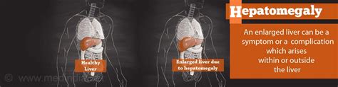 Hepatomegaly - Causes, Symptoms, Diagnosis, Treatment & Prevention