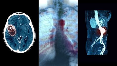 Aneurysm Symptoms and Diagnosis