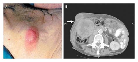 Abdominal-Wall Abscess | NEJM