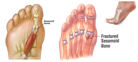 Sesamoiditis - Chicago Foot Care Clinic