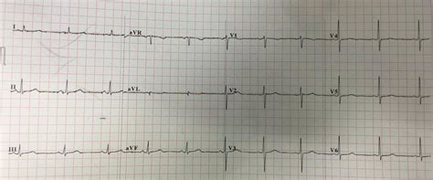 Dr. Smith's ECG Blog: Just as hyperacute T-waves can be reciprocal to T-wave inversion (last ...