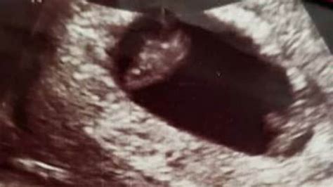 Twin Ultrasound at 6 Weeks: Detection & Risk – About Twins