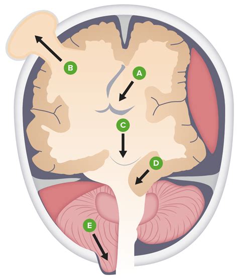 Increased Intracranial Pressure (ICP) | Concise Medical Knowledge