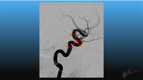 Bouthiller Classification of Internal Carotid Artery Anatomy | UW ...