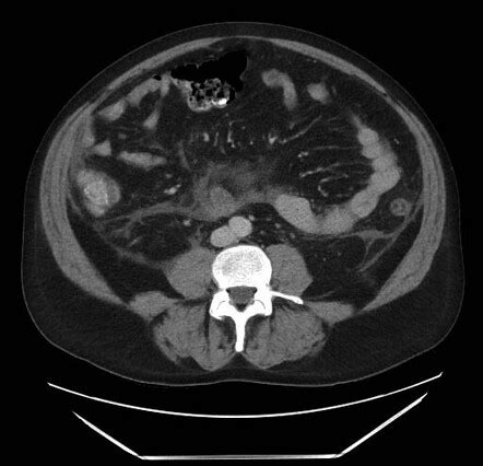 Colon cut-off sign due to pancreatitis | Image | Radiopaedia.org