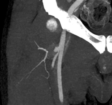 Stent graft exclusion of a mycotic profunda femoris artery pseudoaneurysm with 2-year follow-up ...