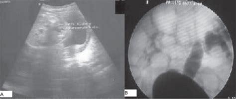 Vesicoureteral Reflux | Concise Medical Knowledge