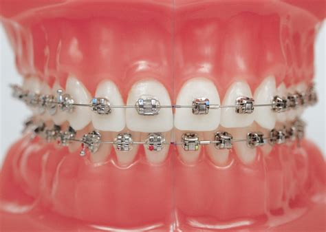 How Much Do Braces Cost in the UK? - The Dental Guide