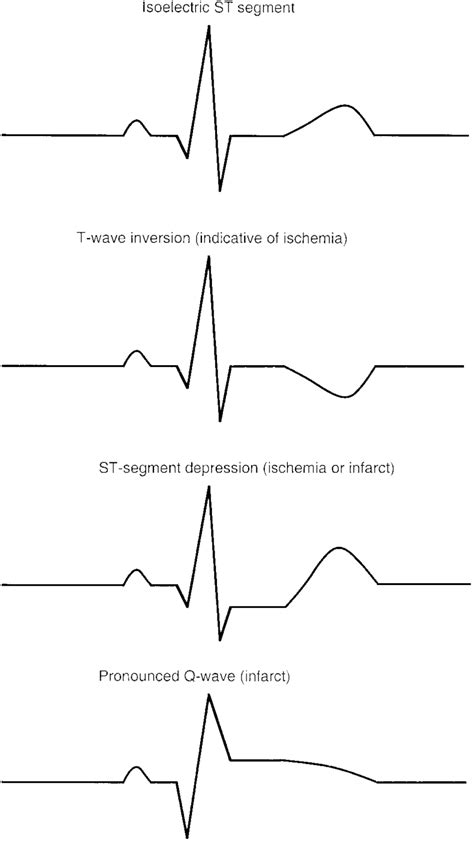 Abnormal Ecg Examples