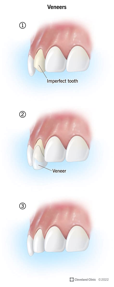 Veneers: What Are Dental Veneers? Cost, Procedure & Advantages