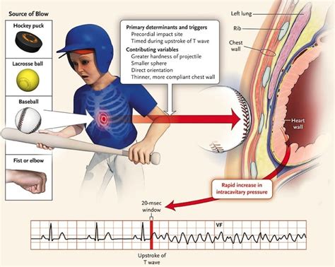 Blunt Cardiac Injury (BCI) - REBEL EM - Emergency Medicine Blog