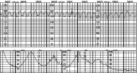 Sinusoidal fetal heart rate