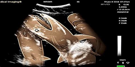 First Ever Ultrasound Image Of A Pregnant Female Shark! - Video - DIVERS24.COM