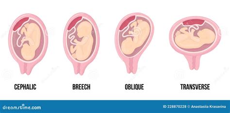 Positions Of Uterus Cartoon Vector | CartoonDealer.com #35980715