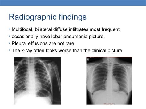 Mycoplasma pneumonia chest x ray findings - varspa