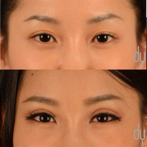 Asian Eyelid Surgery | Asian Blepharoplasty | Asian Eyelid Specialist