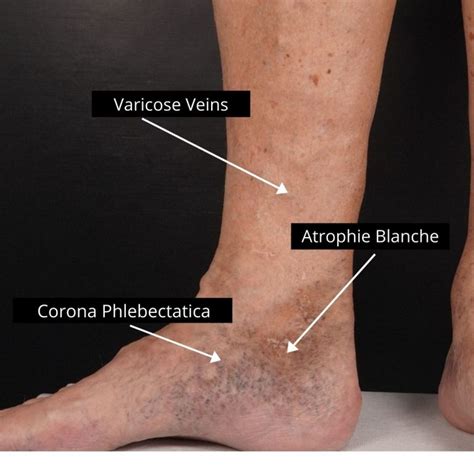 Veins Around Ankles | The VeinCare Centre