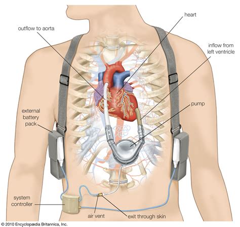 Ventricular assist device (VAD) | Definition, Purpose, & Effectiveness | Britannica