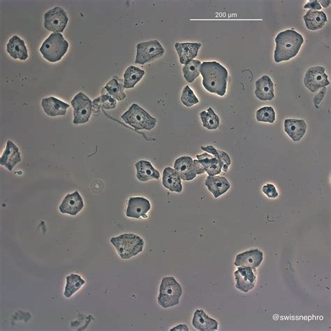 Urine Sediment of the Month: 4 Flavors of Nucleated Cells - Renal Fellow Network