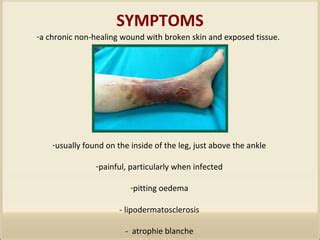 VARICOSE ULCERS | PPT