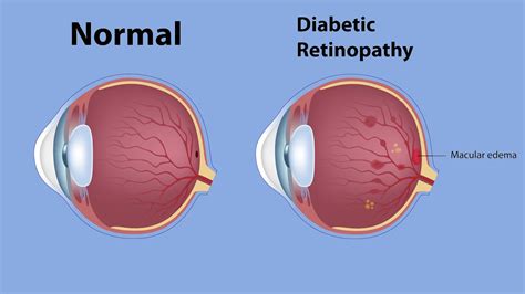 Managing and Treating Diabetic Macular Edema | Christ Memorial