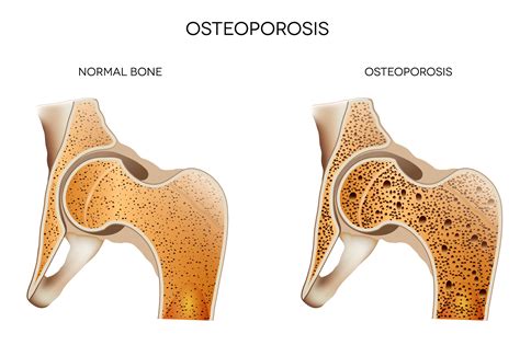 Bone Density Tests: What the Numbers Mean | thirdAGE | healthy living for women + their families