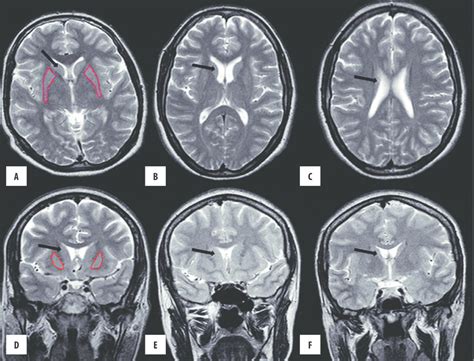 Segmentation method: example for caudate nucleus on a T 2 -weighted MRI... | Download Scientific ...