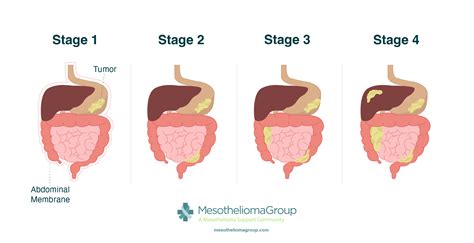 Peritoneal Mesothelioma | Diagnosis, Treatment and Life Expectancy