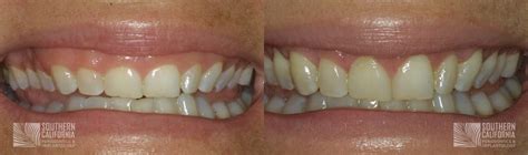 San Diego Crown Lengthening Before & After Photos | Dr. Beck