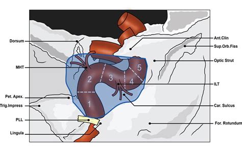 Anatomical Basis of Clinical Manifestations Seen in Cavernous Sinus ...