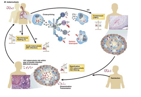 Adding Layers to my Understanding of Tuberculosis — Tracking Zebra